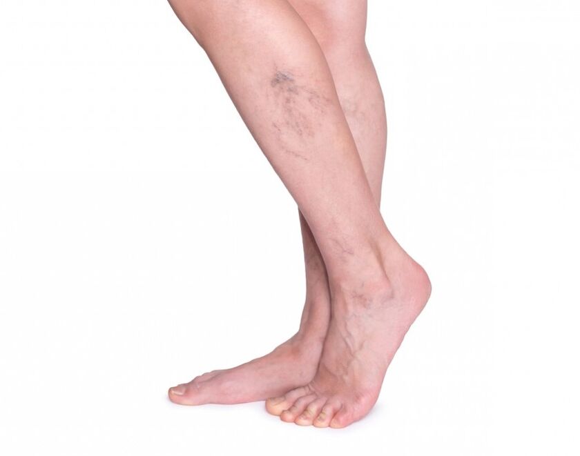 Levicose for varicose veins