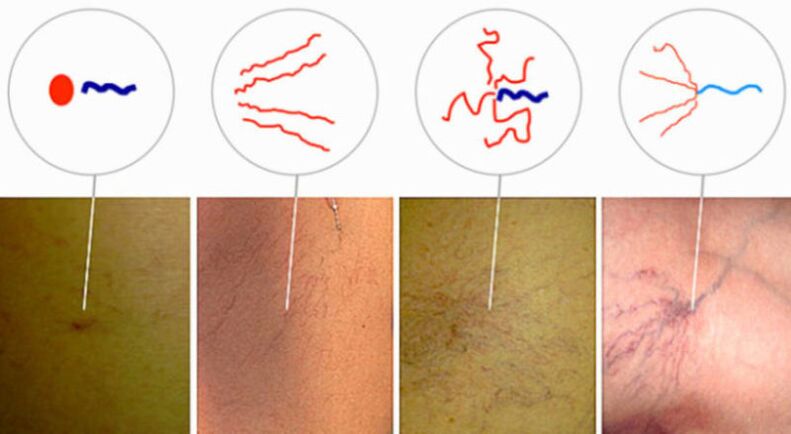 Spider veins in the early stages of varicose veins