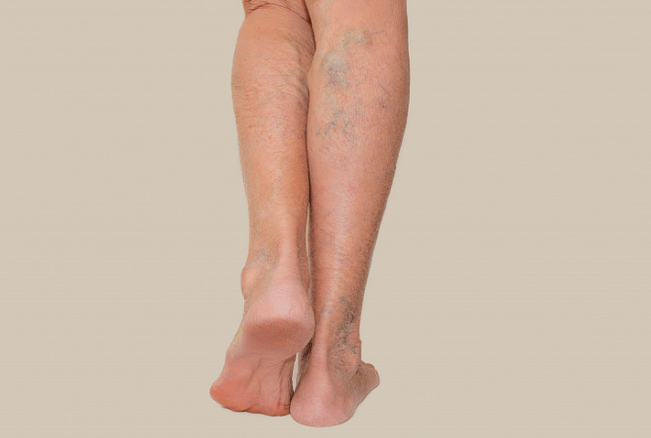 Varicose veins on the legs