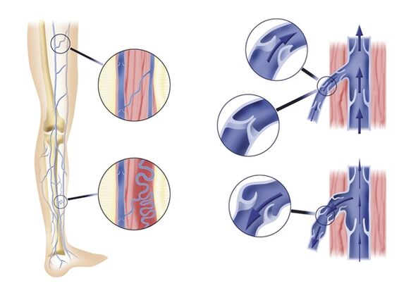 Insufficient venous valves lead to varicose veins