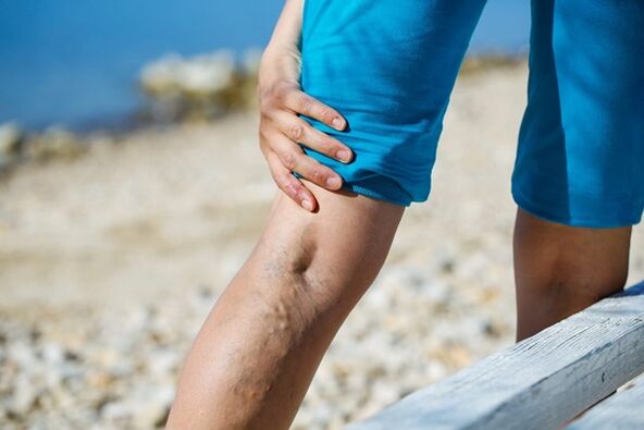 Stitching pain in the legs with varicose veins