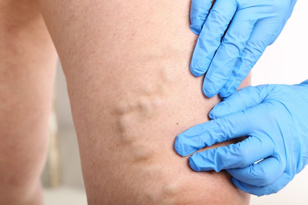 Signs of varicose veins