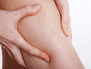 Leg pain with varicose veins