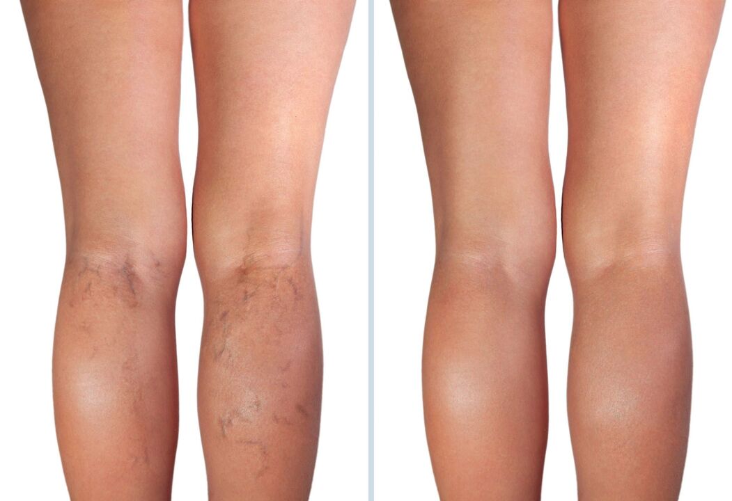 Stages of varicose veins