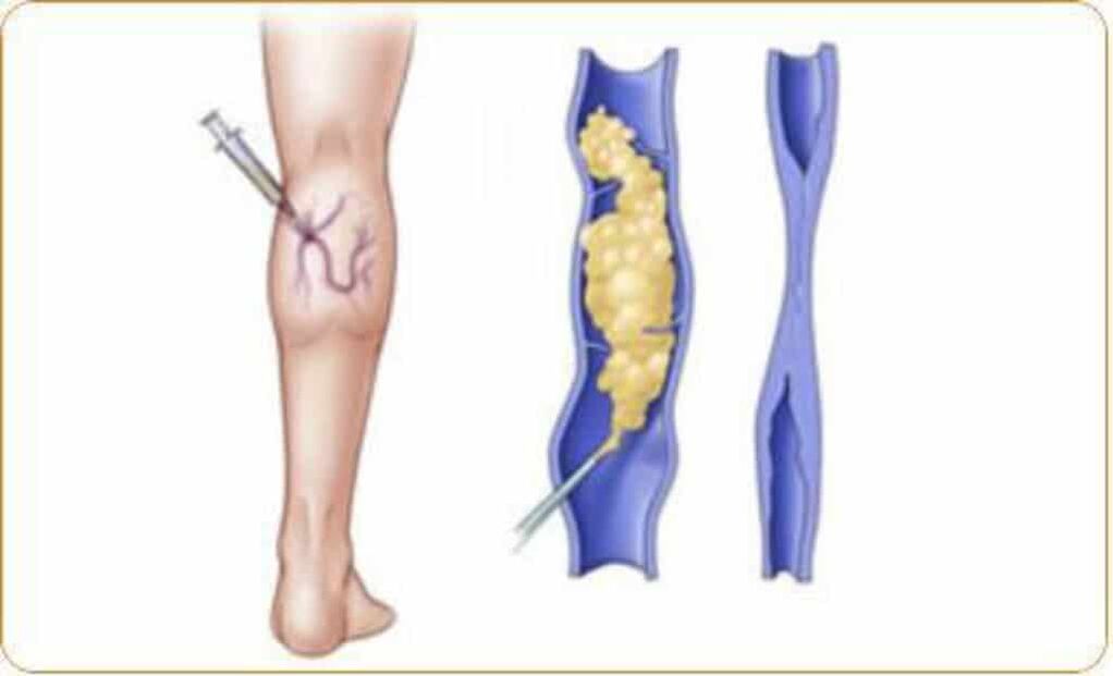 An example of sclerotherapy for varicose veins and a clear result