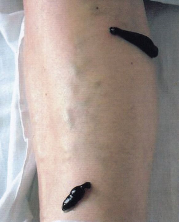 Hirudotherapy – treatment of varicose veins on the legs with leeches